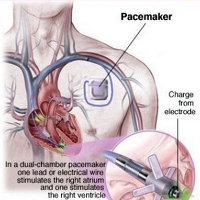 제세동기(ICD)박동기I( Pacemaker)CRT-D